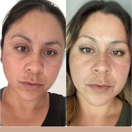 Before and After peel
