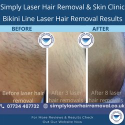 Simply Laser Hair Removal and Skin Clinic - Bikini laser hair removal results showing clear reduction in hair, smoother skin, and visible improvement after multiple treatment sessions.