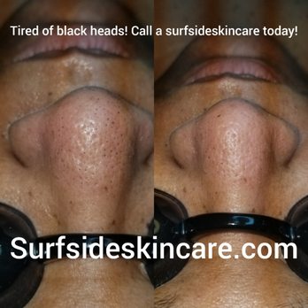 Surfside Skincare - Cleaned out some black heads out of pores - Estheticians Near Me - Carlsbad, California Surfside Skincare - Cleaned out some black heads out of pores - Estheticians Near Me - Carlsbad, California