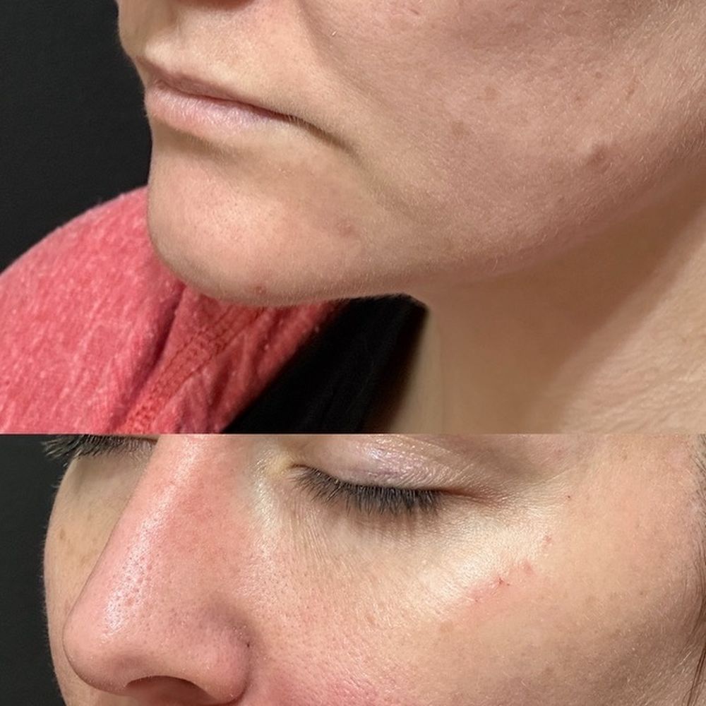 Florida Cosmetic Center - Before lip and line filler and after - Laser Hair Removal Near Me - Celebration, Florida Florida Cosmetic Center - Before lip and line filler and after - Laser Hair Removal Near Me - Celebration, Florida
