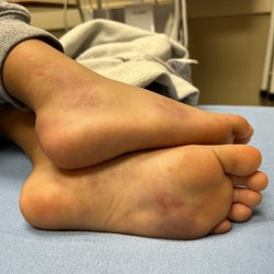 Dignity Health Arizona General Hospital - Mesa - How my son's feet looked when the doctor said maybe it was a mosquito bite and that he'd be fine.
