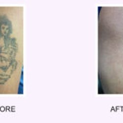 Abington Aesthetic & Laser Medical Center of Plymouth Meeting - Tattoo removal
