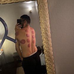 Lux Chiropractic Health Spa - Cupping session was amazing!!!!
