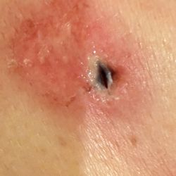 Ocean Drive Plastic Surgery - Infection