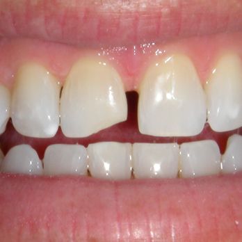 Steven G Kolokithas, DDS - Pre-op bonding - General Dentistry Near Me - Rogers, Arkansas Steven G Kolokithas, DDS - Pre-op bonding - General Dentistry Near Me - Rogers, Arkansas