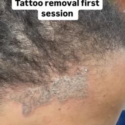 ThrillArts Tattoos - Tattoo removal
