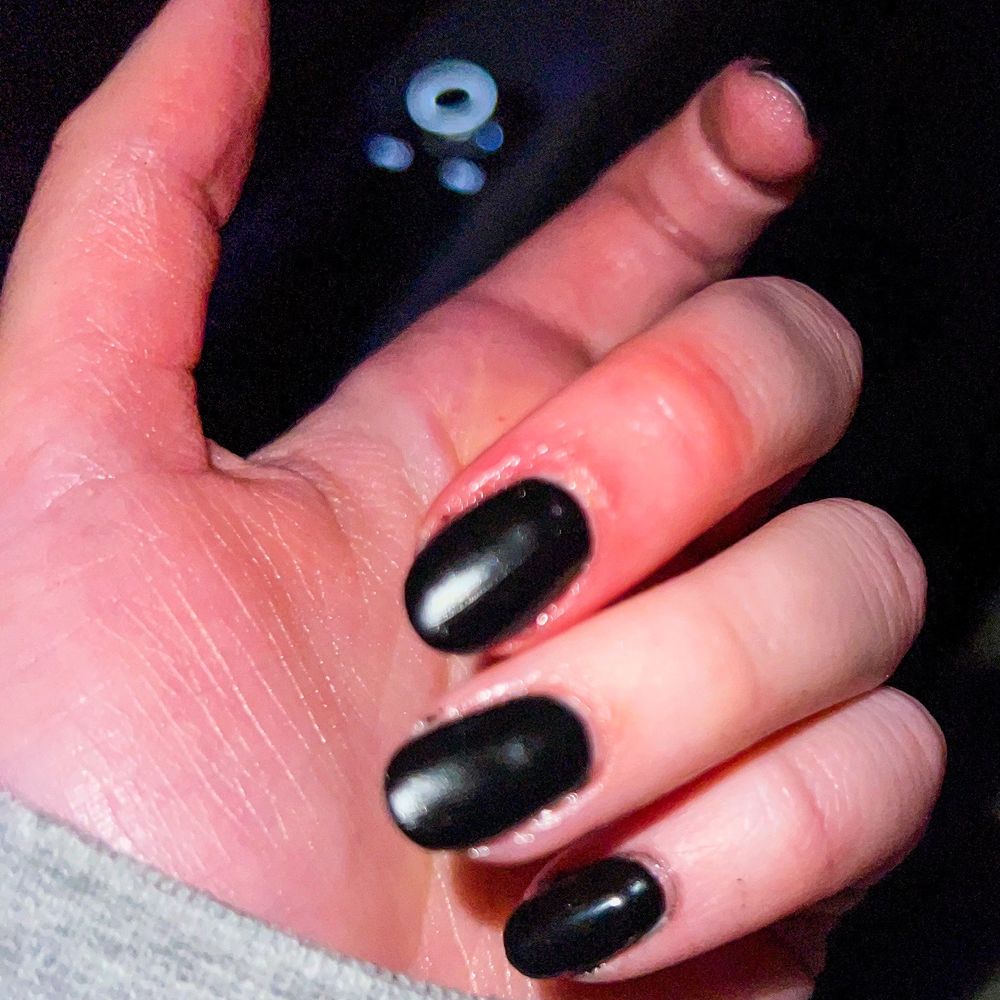 Bruised & swollen finger Bruised & swollen finger
