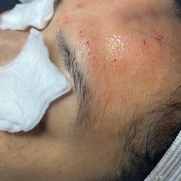 During my session with #micro-needling During my session with #micro-needling