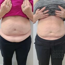 Belleza Med Spa and Clinic - Fat Reduction Injections