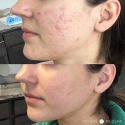 YS Canadian Laser Spa - Microneedling