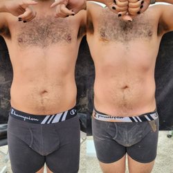 Your Besties Esti - Before ( left photo) and after ( right photo ) ice sculpting session, you can see the client has a more defined waistline