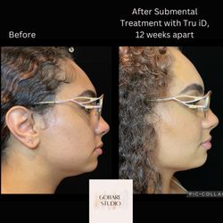 Gobare Aesthetic Studio - Nonsurgical Body Contouring (Sub-mental area)