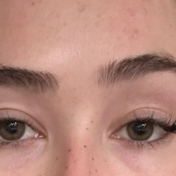 NewSkin Laser Center - Facial paralysis from the Botox. I look like this now from my Botox - Medical Spas Near Me - Simi Valley, California NewSkin Laser Center - Facial paralysis from the Botox. I look like this now from my Botox - Medical Spas Near Me - Simi Valley, California