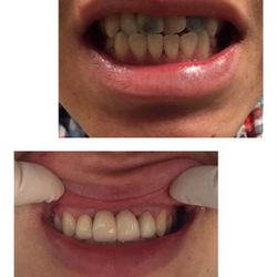 Before and after photos of 4 Zirconia crowns placed on his front teeth. Patient was extremely happy