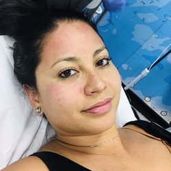 Elite Health Center - Aventura - After treatment on my face. You can see the redness. But surprisingly, after the PRP and cooling mask the redness faded within an hour.