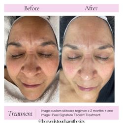 Heavenly Touch Aesthetics - This client's results after using a customized skin care regimen and in office chemical peel treatment.