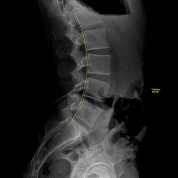 Ke'ale Chiropractic - My x rays from Dr Wyland. - Chiropractors Near Me - Honolulu, Hawaii