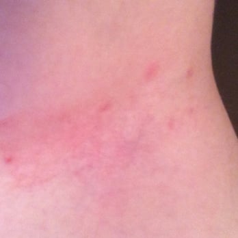 Quest Diagnostics - Allergic reaction to short-term exposure to adhesive. 2 days old. - Laboratory Testing Near Me - Fountain Valley, California Quest Diagnostics - Allergic reaction to short-term exposure to adhesive. 2 days old. - Laboratory Testing Near Me - Fountain Valley, California