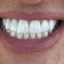 Smile Center - After treatment Emax Veneers