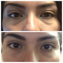 Astra Skin And Laser Solutions - Top is before treatment and below is with juviderm and another filler. Subtle but great results!