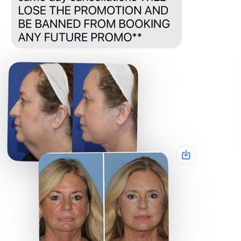 Esthetix MD - NOT THEIR PHOTOS THEY DIDNT DO THESE RESULTS - Skin Care Near Me - San Diego, California Esthetix MD - NOT THEIR PHOTOS THEY DIDNT DO THESE RESULTS - Skin Care Near Me - San Diego, California