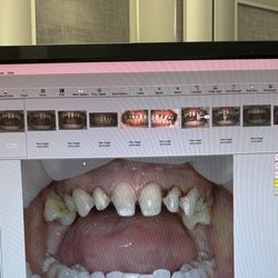 Drew Family Dentistry - This is how much he drilled!!!!