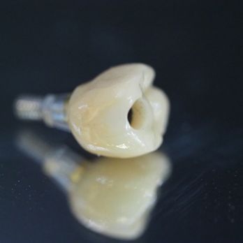 LDL Restorations Dental Lab - Screw retained zirconia crown - Medical Supplies Near Me - Orange, California LDL Restorations Dental Lab - Screw retained zirconia crown - Medical Supplies Near Me - Orange, California