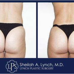 Sheilah A. Lynch, MD - Lynch Plastic Surgery - BBL Before & After Patient (Brazilian Butt Lift) Receive an expert opinion from Board Certified Plastic Surgeon  Dr. Sheilah A. Lynch