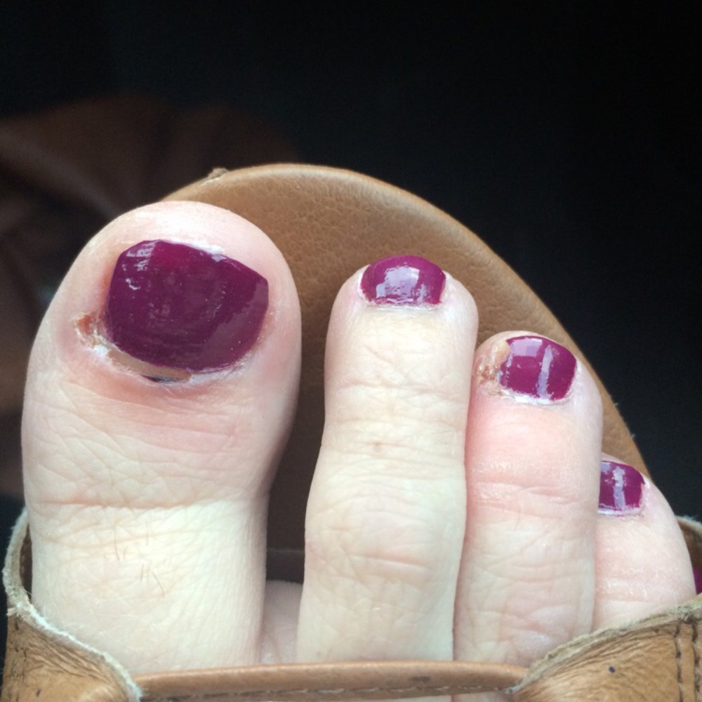 Nails & Spa - This happened to my toes there... Taking the best care of them so I don't get an infection..... - Nail Salons Near Me - White Bear Lake, Minnesota Nails & Spa - This happened to my toes there... Taking the best care of them so I don't get an infection..... - Nail Salons Near Me - White Bear Lake, Minnesota