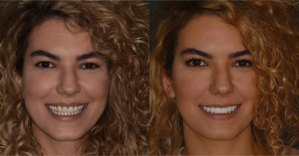 Before and After - Beautiful smile transformations! Before and After - Beautiful smile transformations!