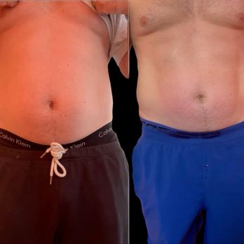 Body Sculpting Santa Barbara - AI-powered body sculpting: melt 2-3 inches off your stomach in 4 hours. Smart, fast, non-invasive. - Body Contouring Near Me - Santa Barbara, California Body Sculpting Santa Barbara - AI-powered body sculpting: melt 2-3 inches off your stomach in 4 hours. Smart, fast, non-invasive. - Body Contouring Near Me - Santa Barbara, California
