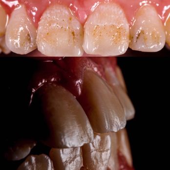 Tibor Forai, DDS - Before and after bonding on front teeth - Cosmetic Dentists Near Me - West Hollywood, California Tibor Forai, DDS - Before and after bonding on front teeth - Cosmetic Dentists Near Me - West Hollywood, California