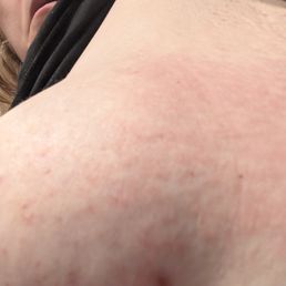 Bacterial rash on underarm Bacterial rash on underarm