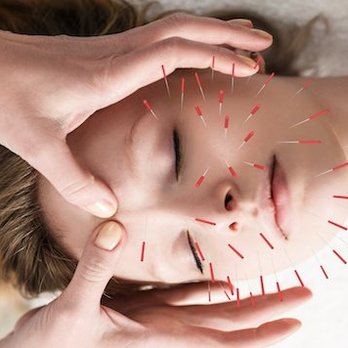 Magic TCM - Facial Rejuvenation 02 - Acupuncture Near Me - San Antonio, Texas Magic TCM - Facial Rejuvenation 02 - Acupuncture Near Me - San Antonio, Texas