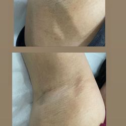 Le Belle Skin Laser