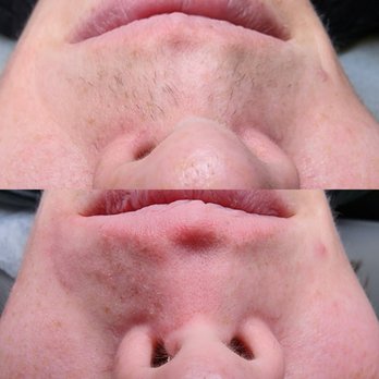 Meadowlark Electrolysis - Hair Removal Near Me - Missoula, Montana Meadowlark Electrolysis - Hair Removal Near Me - Missoula, Montana