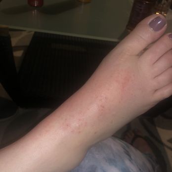 Paris Nails & Spa - This photo doesn't do Justice but it's bad. Benadryl only helps so much. - Nail Salons Near Me - Camarillo, California Paris Nails & Spa - This photo doesn't do Justice but it's bad. Benadryl only helps so much. - Nail Salons Near Me - Camarillo, California