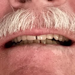 Affordable Dentures #01009016 - My new teeth, (uppers).  Thanks Dr Stagg and staff.  Affordable Dentures is the BEST!