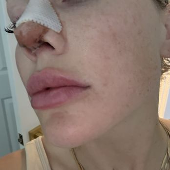 John Frederick, MD - Post op (easiest recovery I've ever had and this is my fourth revision). - Plastic Surgeons Near Me - Beverly Hills, California John Frederick, MD - Post op (easiest recovery I've ever had and this is my fourth revision). - Plastic Surgeons Near Me - Beverly Hills, California