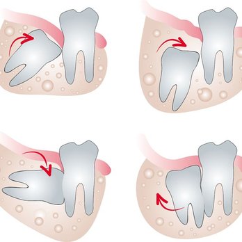 All Dental - Wisdom Teeth Extraction, Gentle & Painless. Wisdom Teeth Removal Arlington, with OR without Insurance. FREE Consult (817) 462-0007 - Pediatric Dentists Near Me - Arlington, Texas All Dental - Wisdom Teeth Extraction, Gentle & Painless. Wisdom Teeth Removal Arlington, with OR without Insurance. FREE Consult (817) 462-0007 - Pediatric Dentists Near Me - Arlington, Texas