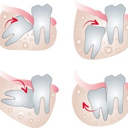 All Dental - Wisdom Teeth Extraction, Gentle & Painless. Wisdom Teeth Removal Arlington, with OR without Insurance. FREE Consult (817) 462-0007