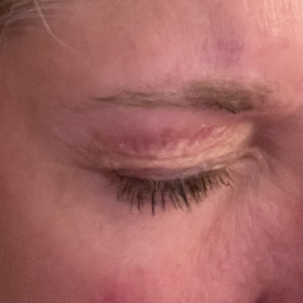 Burn from eyebrow wax