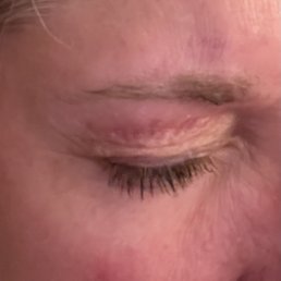 Burn from eyebrow wax Burn from eyebrow wax