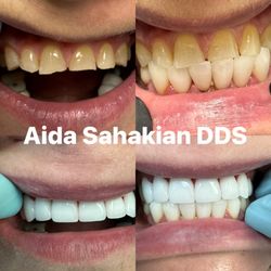 Aida Sahakian, DDS - Upper zirconium crowns