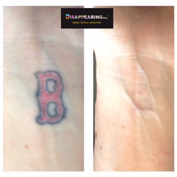 Disappearing inc - Love the Sox!  Just not the placement! - Tattoo Removal Near Me - Northampton, Massachusetts