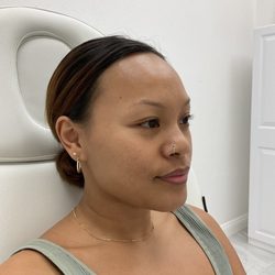 Locococo Aesthetix - BEFORE 1/2 Syringe Dermal Fillers and Botox to 11 line frown lines and muscle above inner eyebrow.
