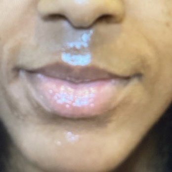 Simply Injectables  - Front view Before injections - Medical Spas Near Me - Providence, Rhode Island