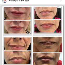 Radiance Medspa - Beautiful lips in all shapes and sizes, customized based on patients' request!