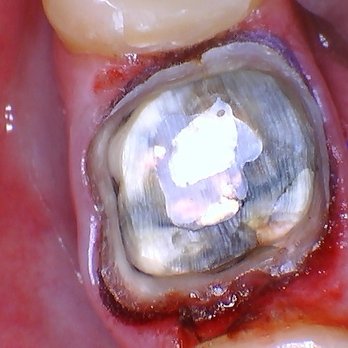 Big Gay Smiles - Before: tooth prepped to receive the new crown. - General Dentistry Near Me - Washington, DC, District of Columbia Big Gay Smiles - Before: tooth prepped to receive the new crown. - General Dentistry Near Me - Washington, DC, District of Columbia