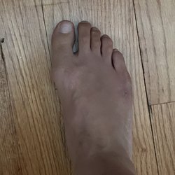 Silver Larry M Podiatrist - Healed 4 weeks after